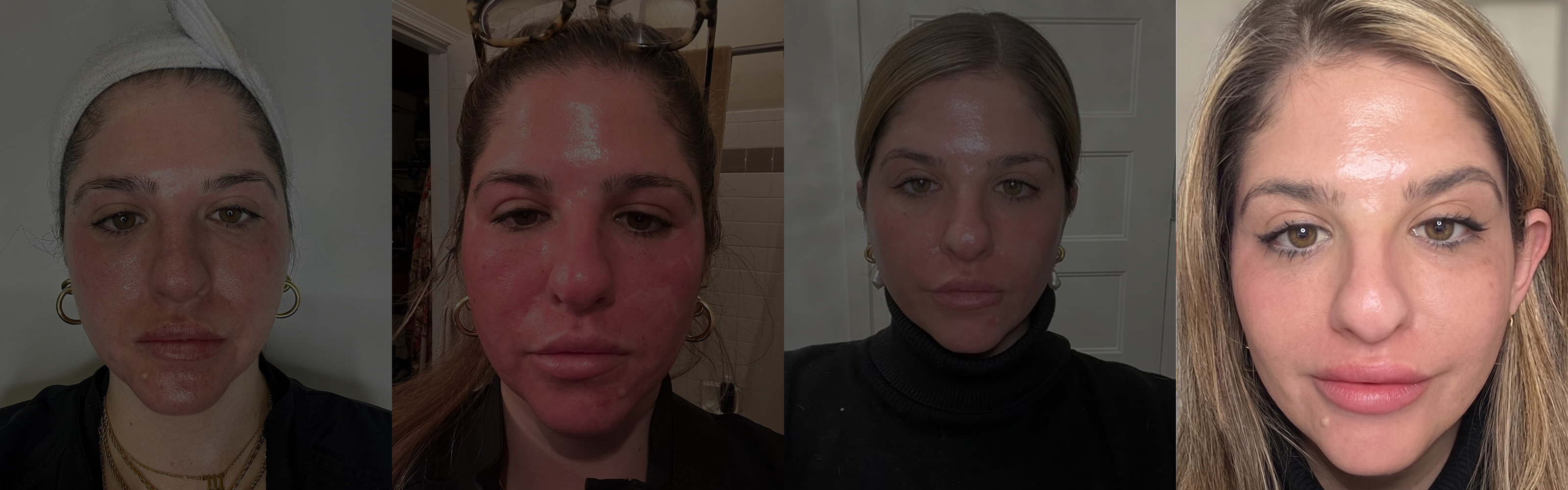 1 Months Post-Treatment