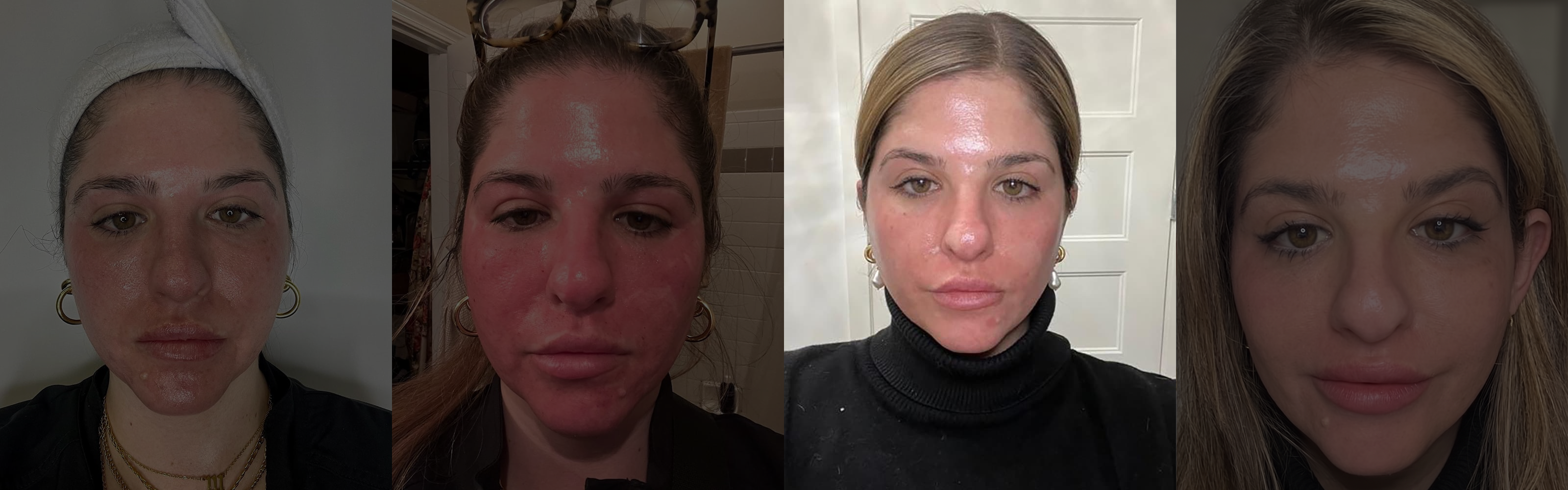 1 Week Post-Treatment