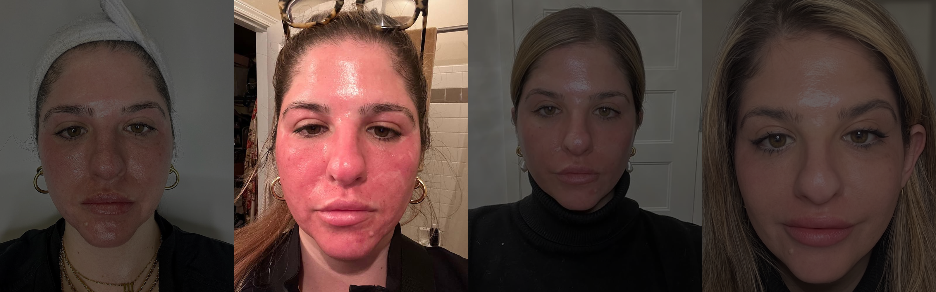 Day After Treatment
