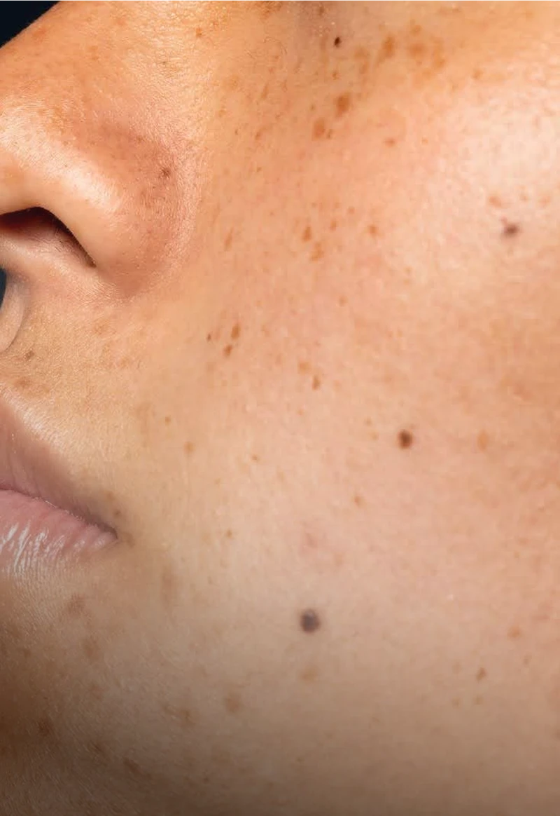 Excess Melanin Production