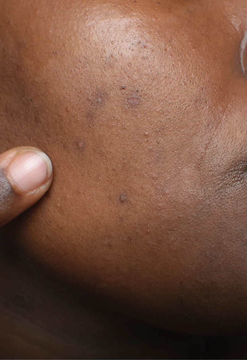 Post-Inflammatory Pigmentation