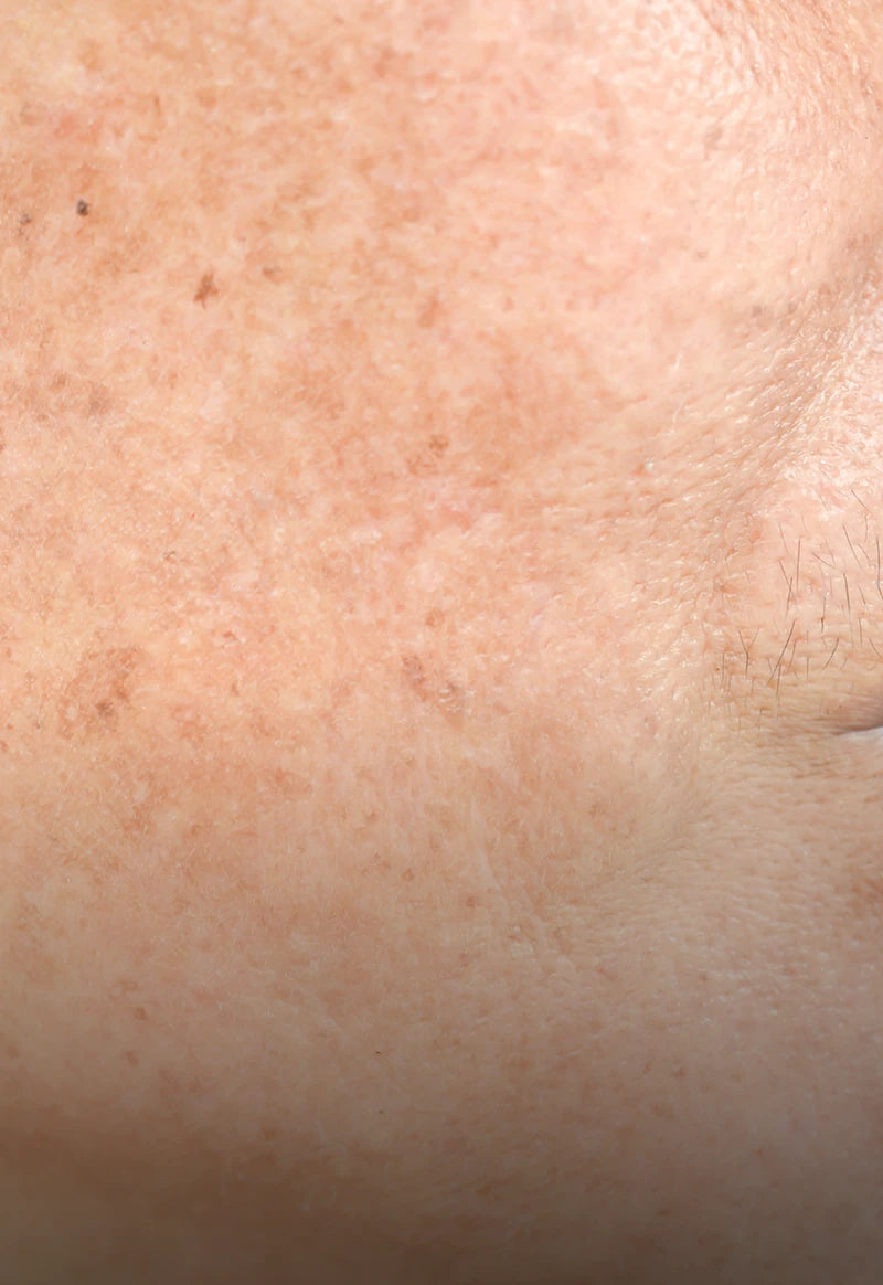 Hormones & Cumulative Sun Exposure