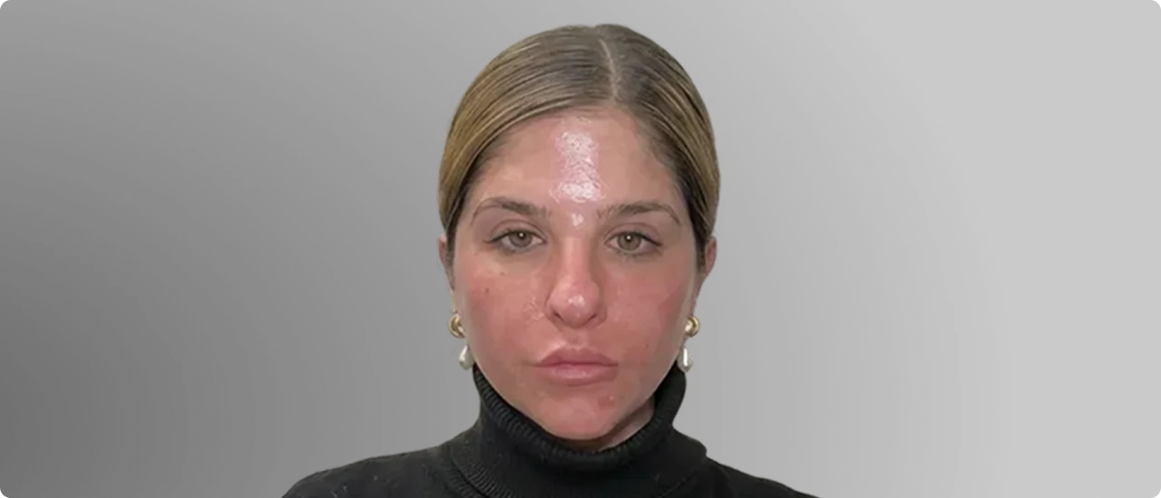 1 Week Post-Treatment